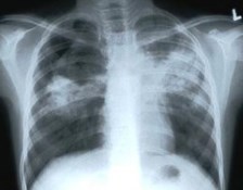 TB x-ray image