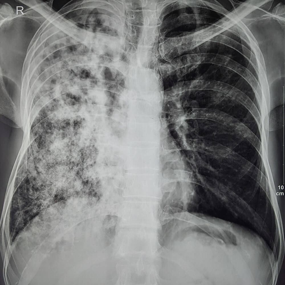 Tuberculosis